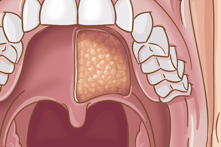 Salivary gland cancer